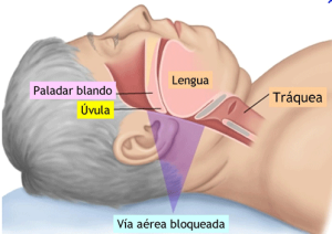 apnea3